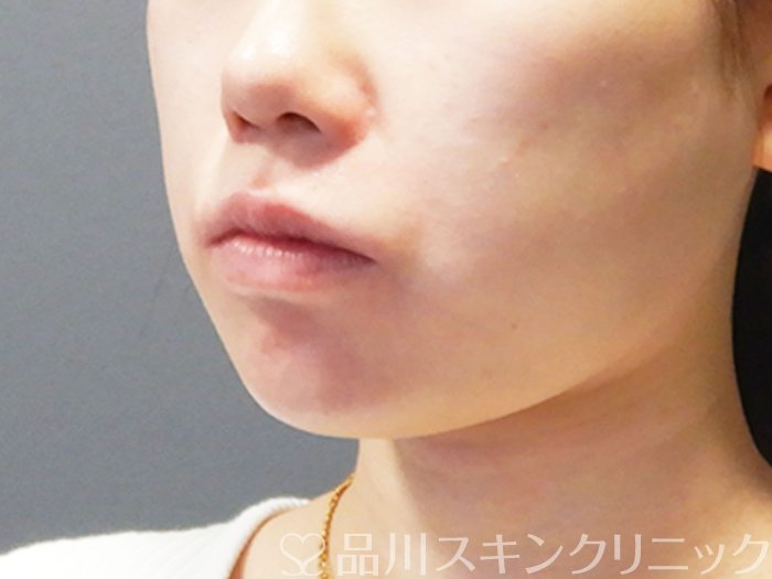 症例NO.73277のBEFORE写真