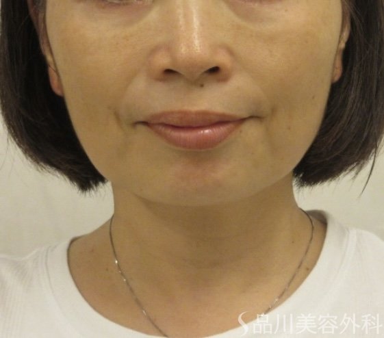 症例NO.71567のBEFORE写真