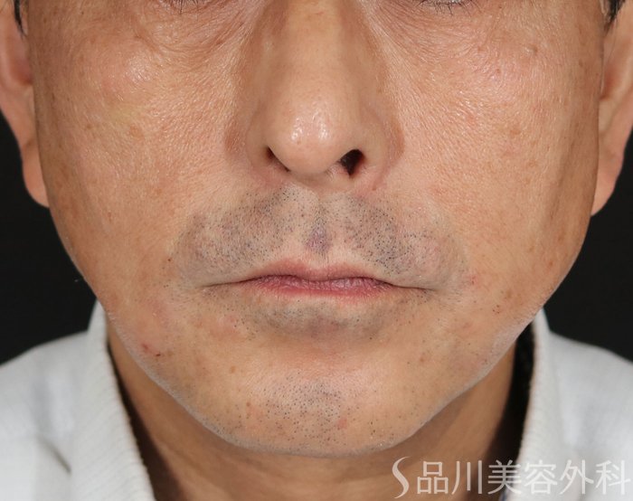症例NO.71607のAFTER写真