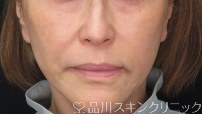 症例NO.70826のBEFORE写真