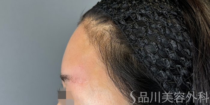 症例NO.66205のAFTER写真