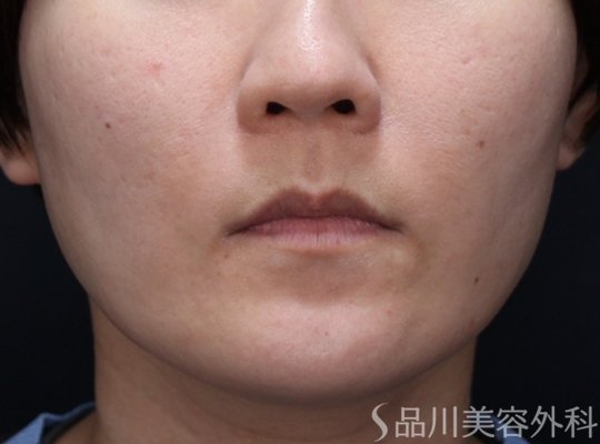 症例NO.74046のBEFORE写真