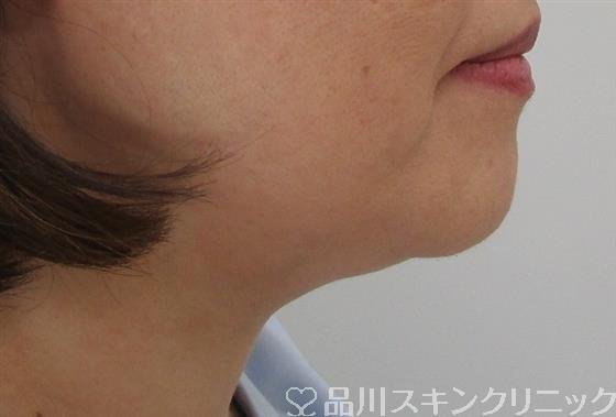 症例NO.42236のAFTER写真