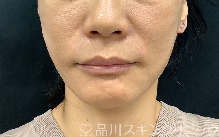 症例NO.71276のAFTER写真