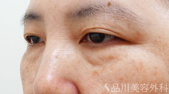 症例NO.69437のBEFORE写真