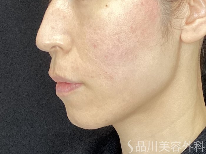 症例NO.72126のAFTER写真