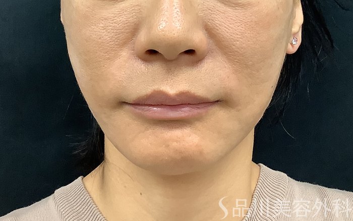 症例NO.71276のAFTER写真
