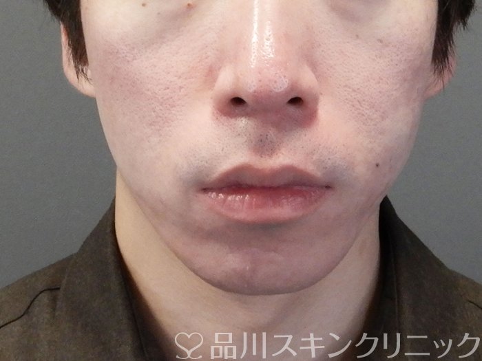 症例NO.69645のAFTER写真