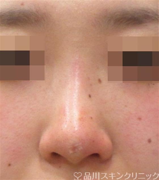 症例NO.27138のAFTER写真