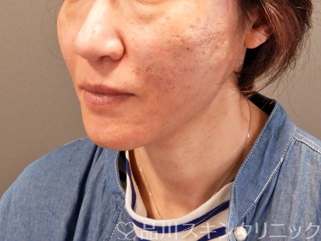 症例NO.69748のAFTER写真