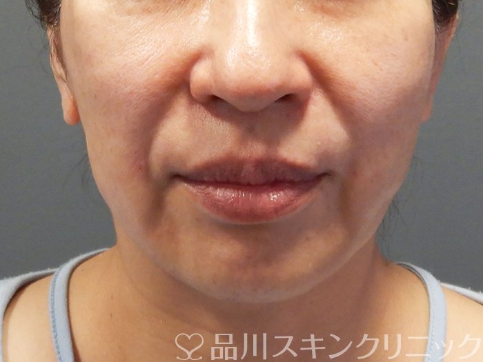 症例NO.70602のAFTER写真