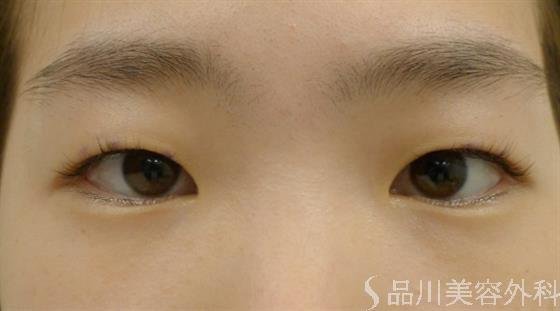症例NO.35688のBEFORE写真