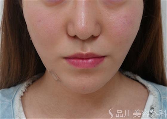 症例NO.26044のAFTER写真