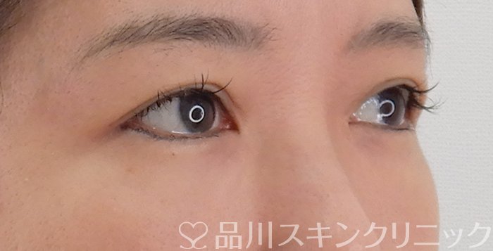 症例NO.62183のAFTER写真