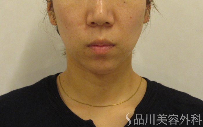 症例NO.73931のBEFORE写真