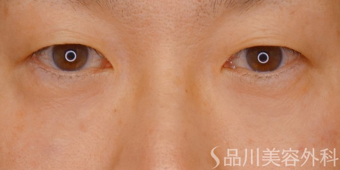 症例NO.71057のAFTER写真