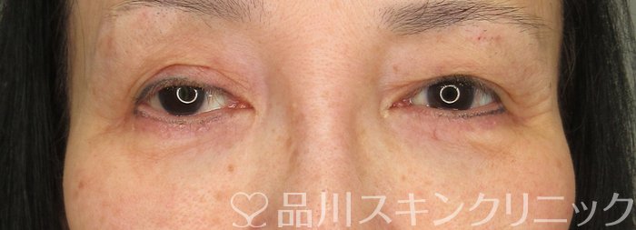 症例NO.74062のBEFORE写真