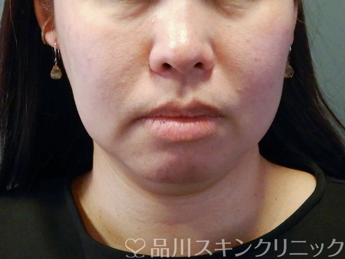 症例NO.62792のBEFORE写真