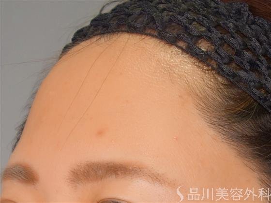 症例NO.55057のBEFORE写真