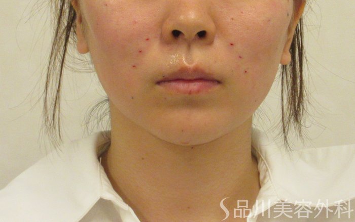 症例NO.72461のAFTER写真