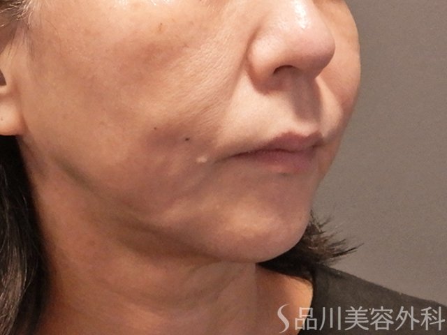 症例NO.72789のAFTER写真