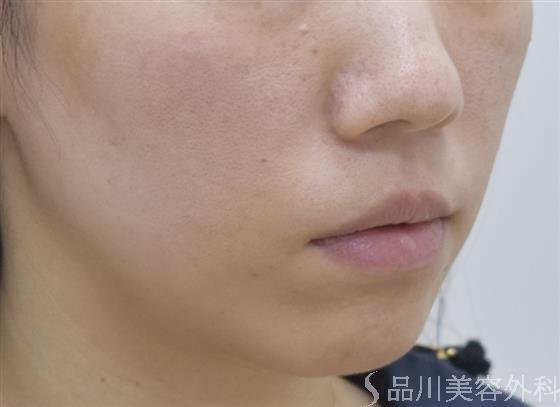 症例NO.47340のBEFORE写真