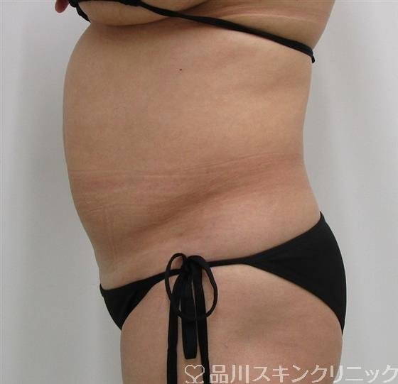 症例NO.35946のBEFORE写真