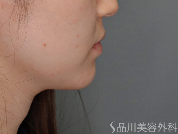 症例NO.69345のBEFORE写真