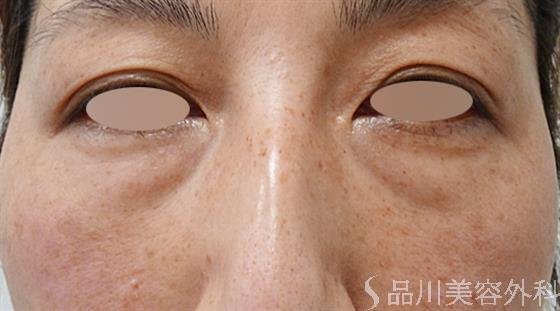 症例NO.50882のBEFORE写真