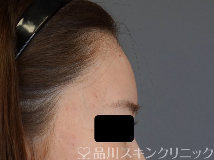 症例NO.74120のAFTER写真