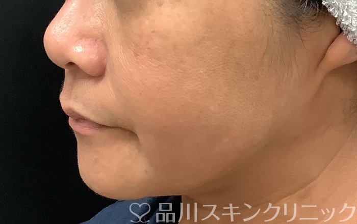 症例NO.69378のBEFORE写真