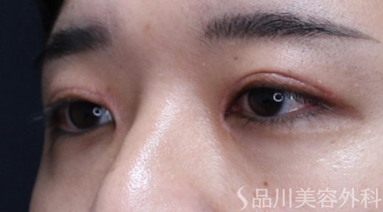 症例NO.71507のAFTER写真