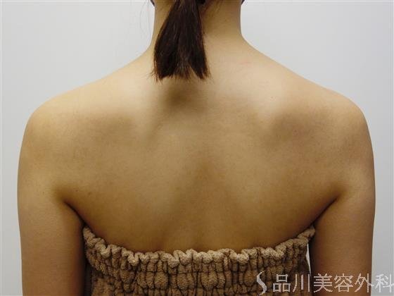 症例NO.50368のAFTER写真