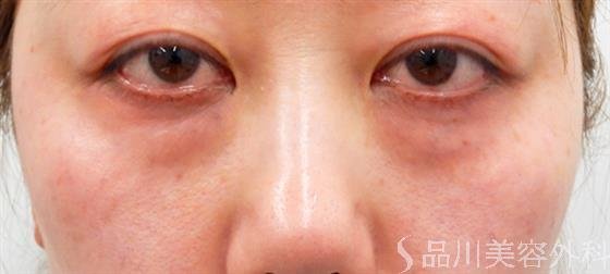 症例NO.50465のBEFORE写真