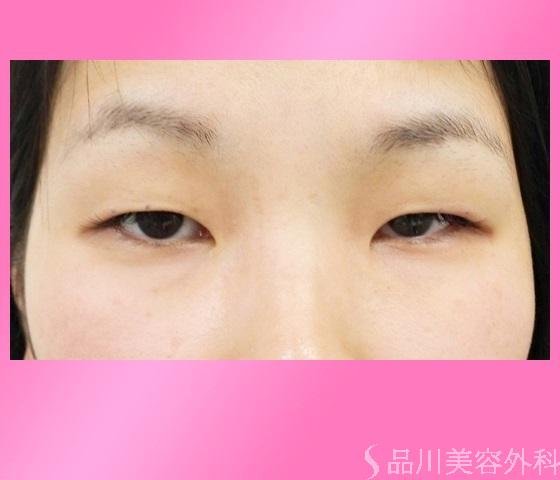 症例NO.17076のBEFORE写真