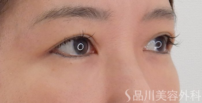 症例NO.62183のAFTER写真
