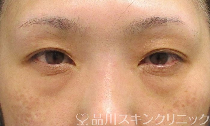 症例NO.71844のBEFORE写真