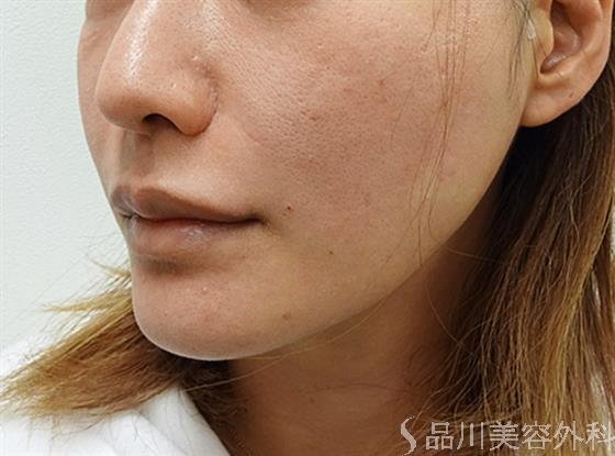 症例NO.34408のAFTER写真