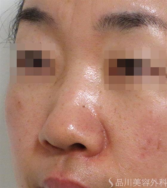 症例NO.36508のBEFORE写真