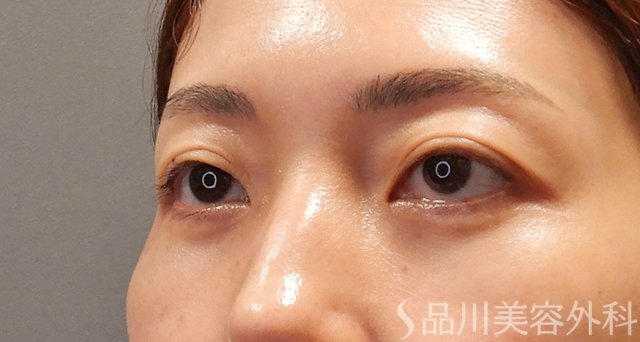 症例NO.74880のAFTER写真