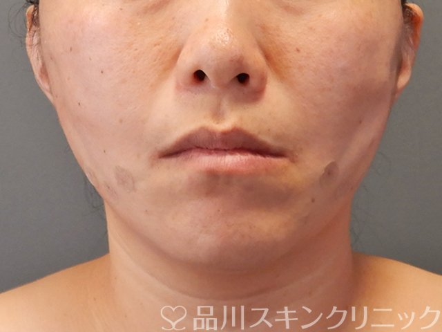 症例NO.75062のAFTER写真