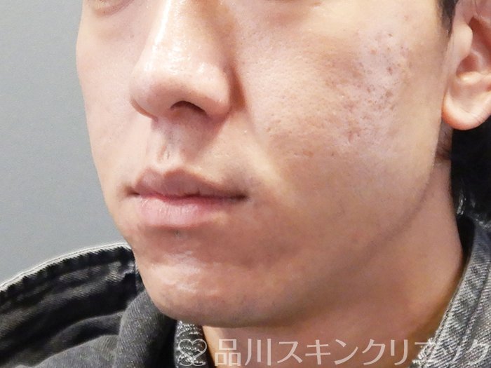 症例NO.73208のBEFORE写真