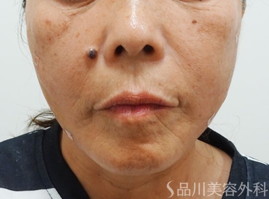 症例NO.73210のAFTER写真