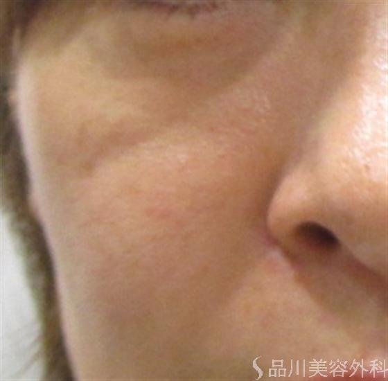 症例NO.19787のBEFORE写真