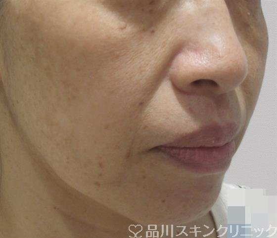 症例NO.38247のBEFORE写真
