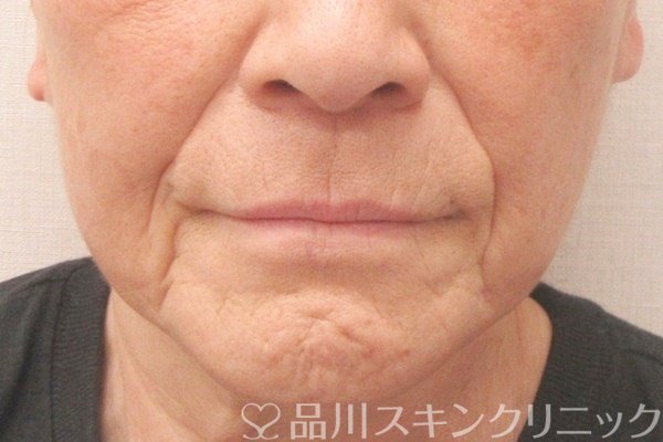 症例NO.70880のBEFORE写真