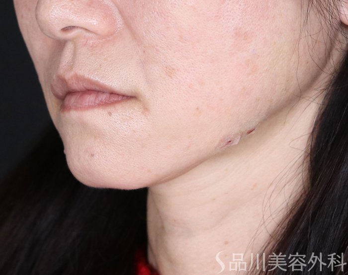 症例NO.72644のAFTER写真