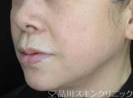 症例NO.70042のAFTER写真