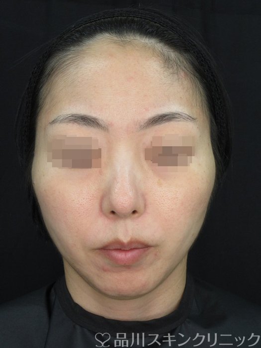 症例NO.72424のBEFORE写真