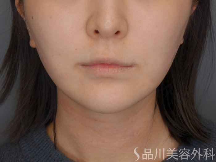 症例NO.72913のAFTER写真